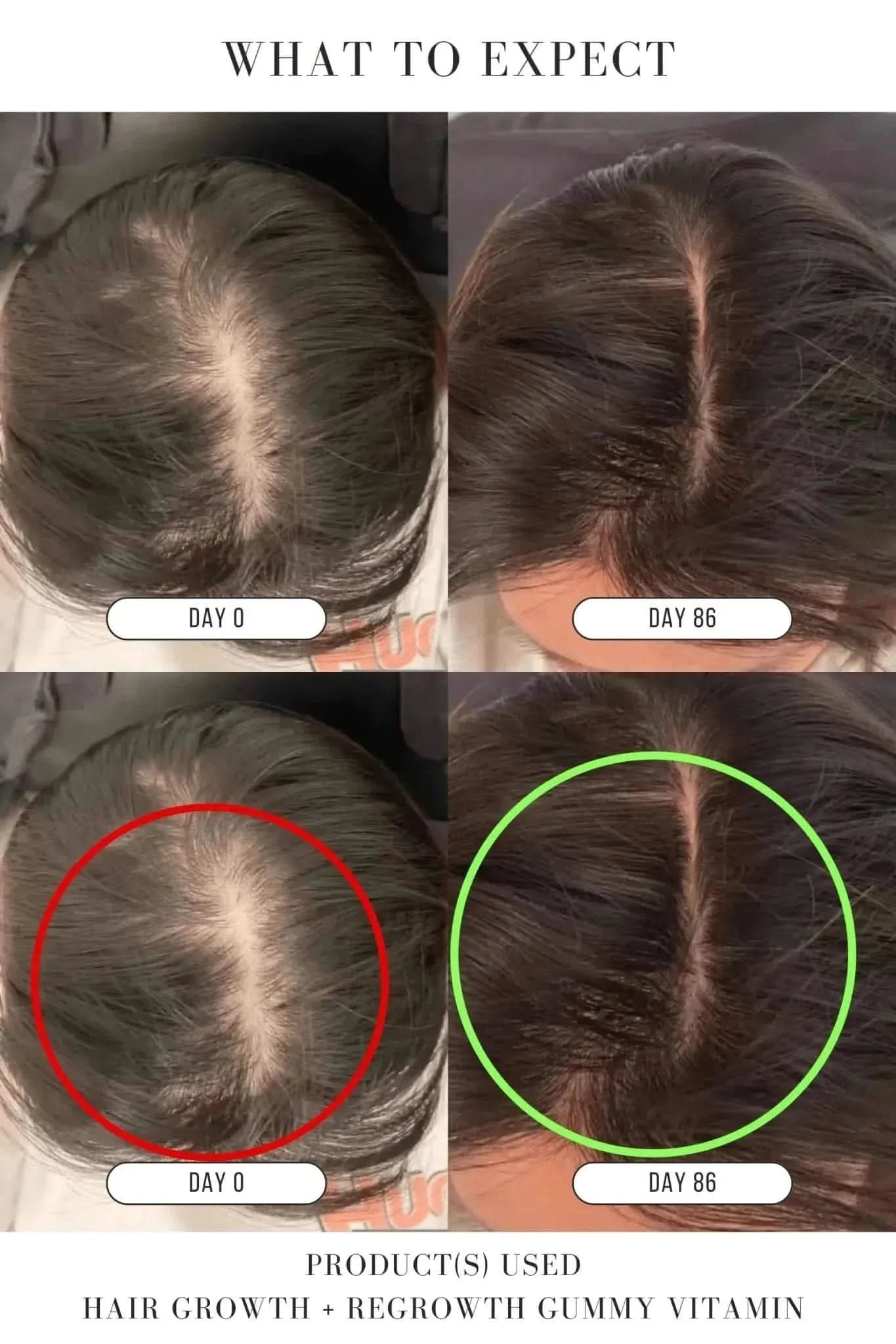 Hair Growth + Regrowth Gummy Vitamin (1-Month Supply)