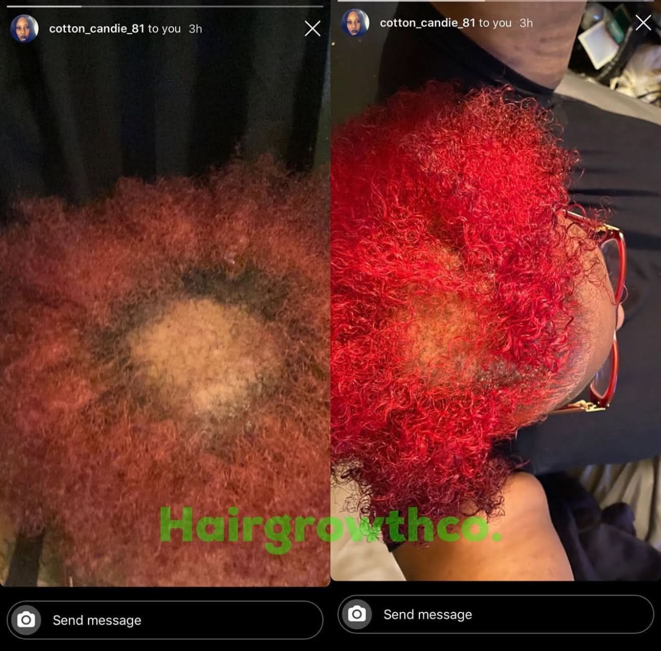 Hair Growth + Regrowth Gummy Vitamin (1-Month Supply)