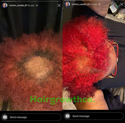 Hair Growth + Regrowth Gummy Vitamin (1-Month Supply)