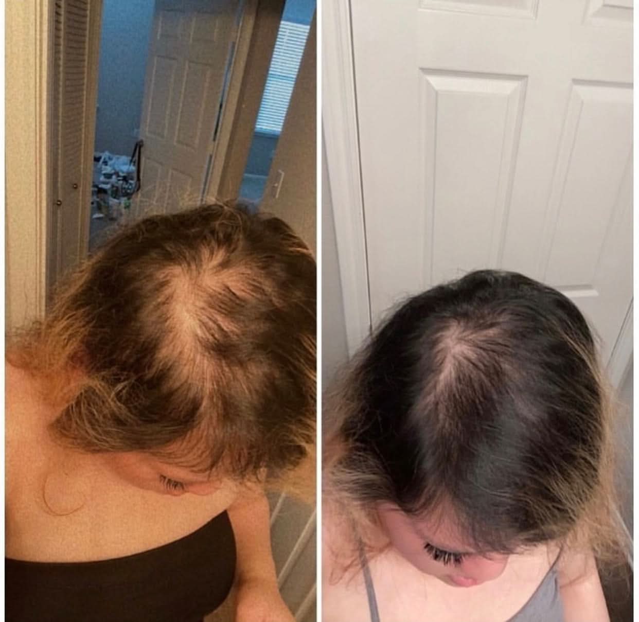 Image of Hair Growth + Regrowth Gummy Vitamin (1-Month Supply)