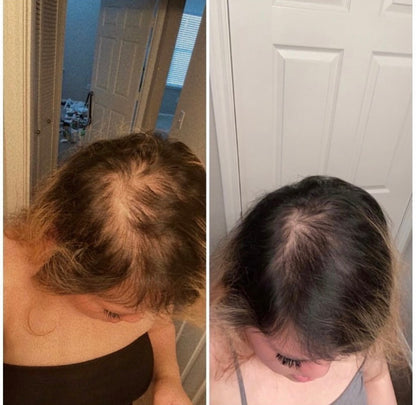 Hair Growth + Regrowth Gummy Vitamin (1-Month Supply)