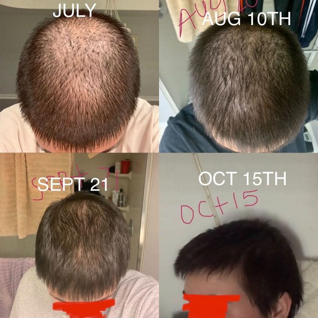 Hair Growth + Regrowth Gummy Vitamin (1-Month Supply)