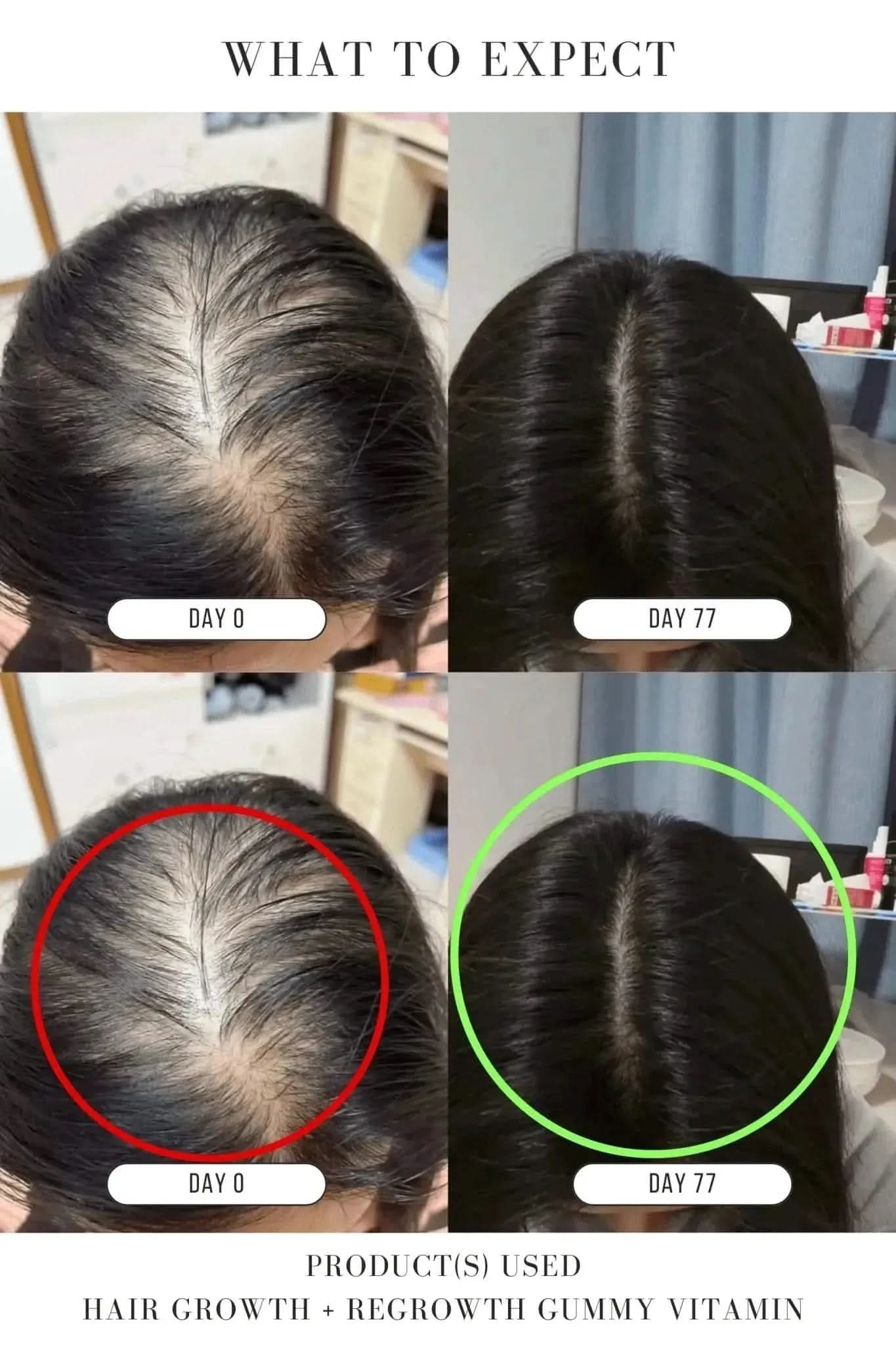 Hair Growth + Regrowth Gummy Vitamin (1-Month Supply)