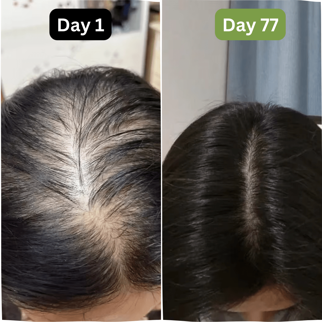 Hair Growth + Regrowth Gummy Vitamin (1 - Month Supply) - Hair Growth Co