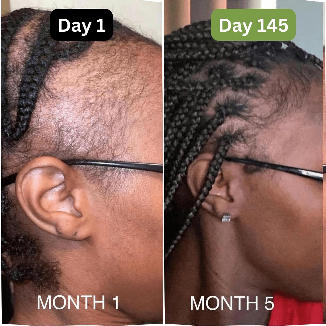 Hair Growth + Regrowth Gummy Vitamin (1 - Month Supply) - Hair Growth Co