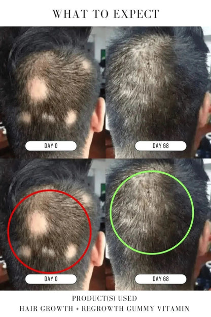 Hair Growth + Regrowth Gummy Vitamin (1-Month Supply)