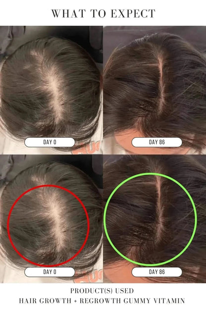 Hair Growth + Regrowth Gummy Vitamin (1-Month Supply)