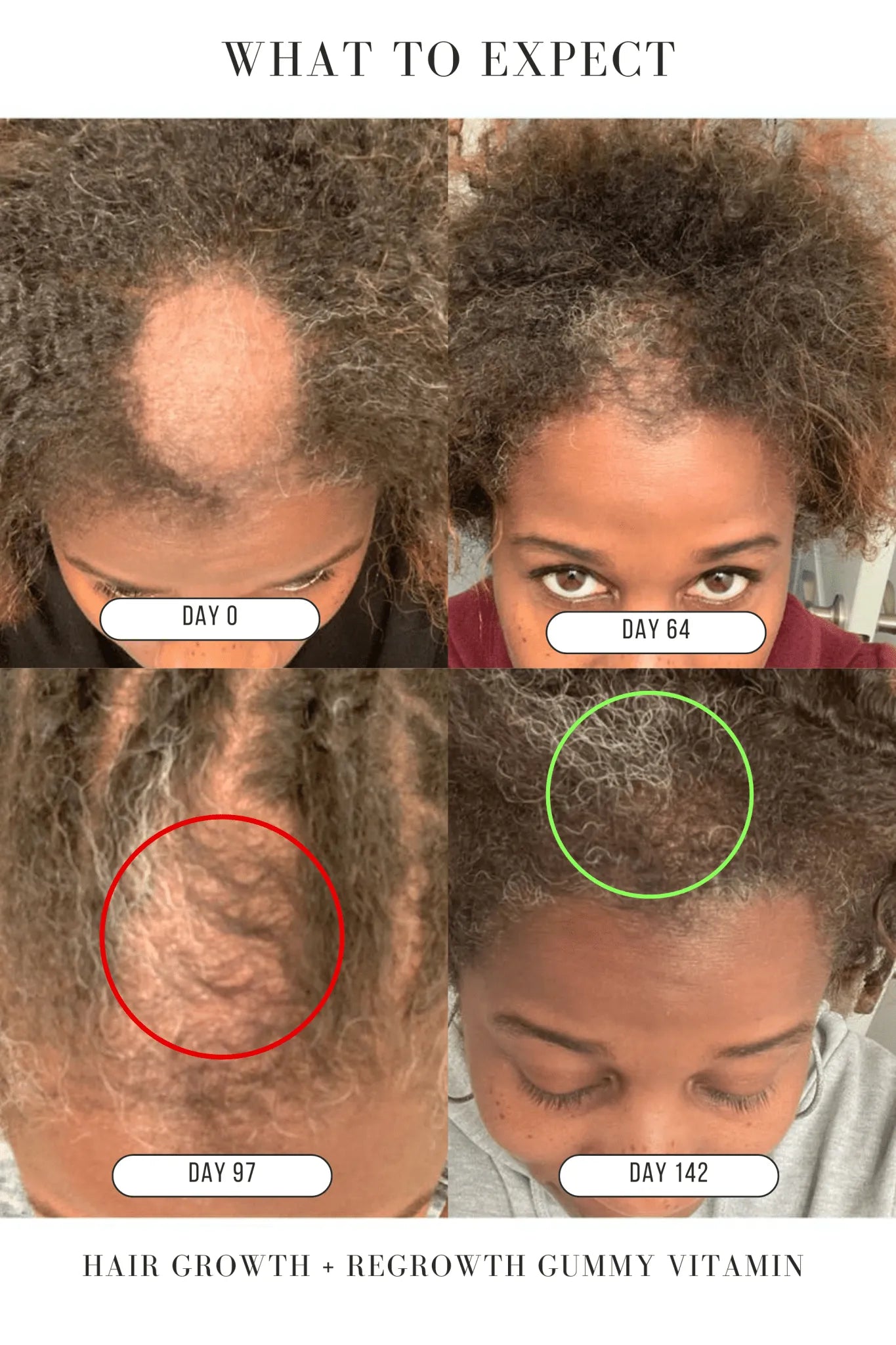 Hair Growth + Regrowth Gummy Vitamin (1 - Month Supply) - Hair Growth Co
