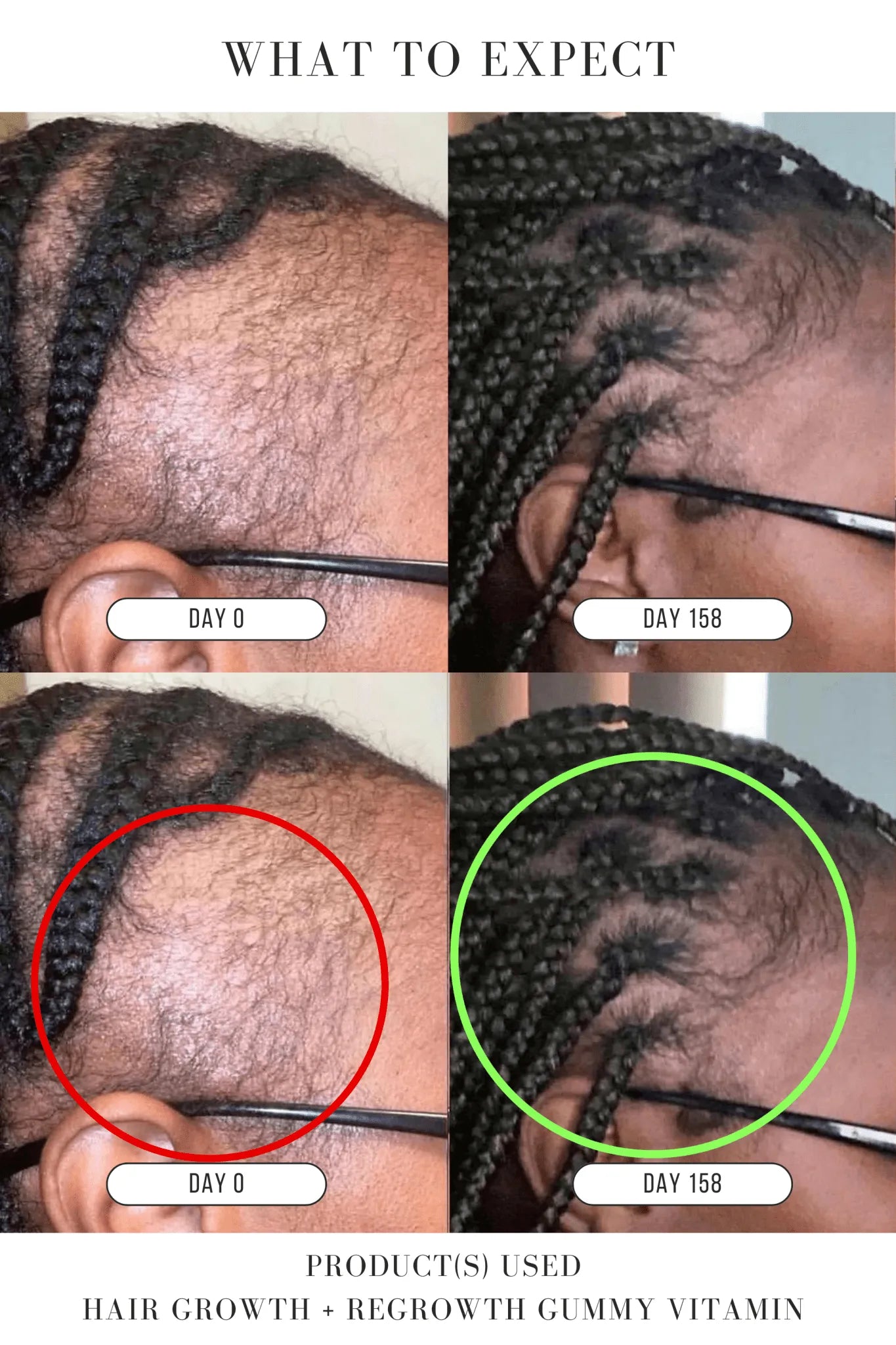 Hair Growth + Regrowth Gummy Vitamin (1 - Month Supply) - Hair Growth Co