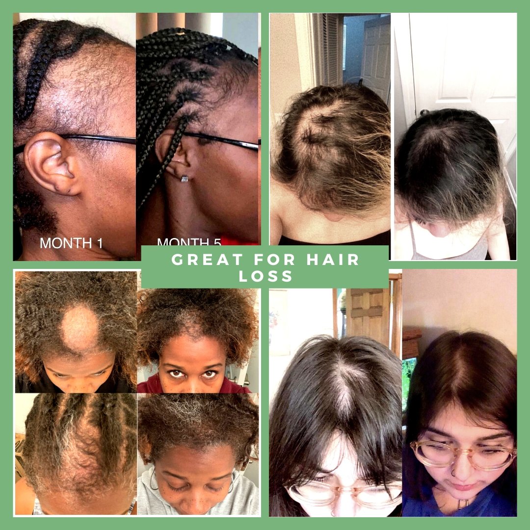 ⭐JUMBO⭐ 10 in 1 Hair Growth Oil (8 Oz.)(4X the Size!) - Hair Growth Co