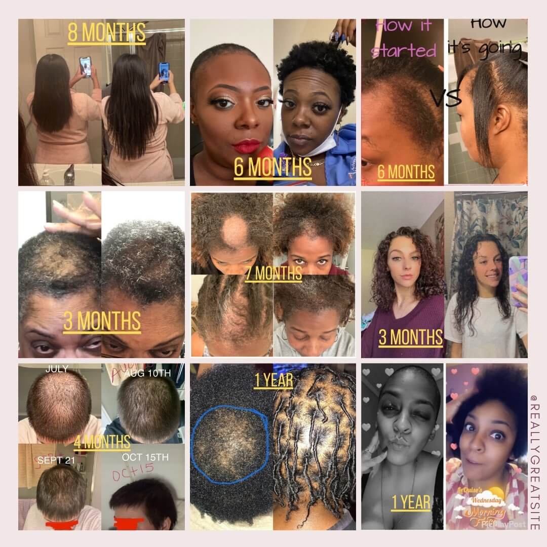 3 month hair growth progress photo! Super excited to growing so fast. I'm  conflicted because it's growing uneve… | Hair growth, Hair growth progress,  Hair treatment